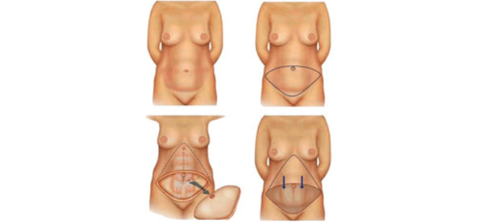 Fig. 1. Esquema mostrando uma abdominoplastia convencional